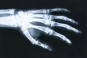 Neznámý: Rentgenový snímek lidské ruky